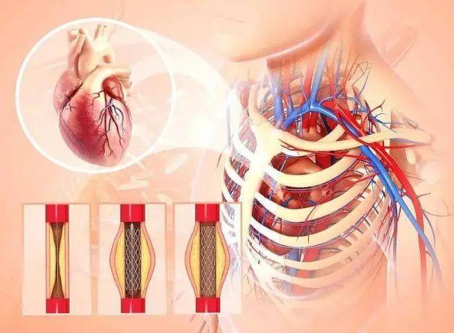“最新国产心脏支架价格一览”